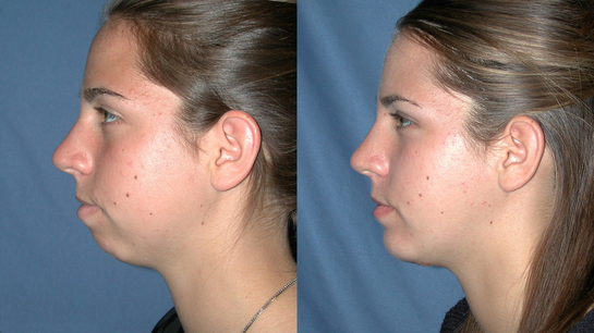 Genioplasty Results - Dr Mark Kohout