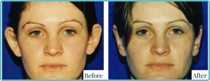 Otoplasty Surgery Gallery Before and After Image