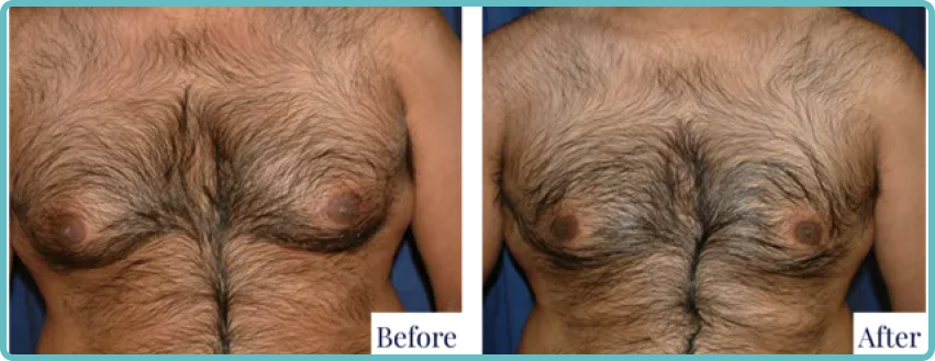 Male Breast Revision Surgery Gallery Before and After Image
