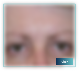 Blepharoplasty Sydney