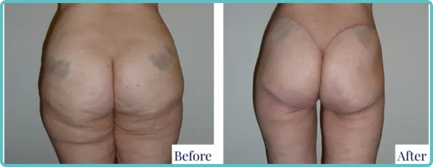 Bodylift Surgery Faqs - Before and After image