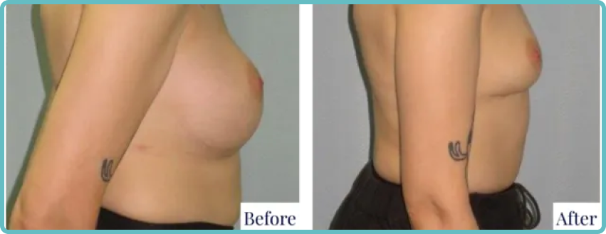 Breast Revision Surgery Gallery Before and After Image