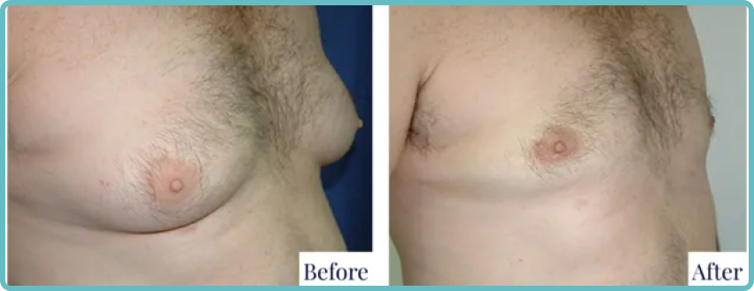 Male Breast Revision Surgery Gallery Before and After Image