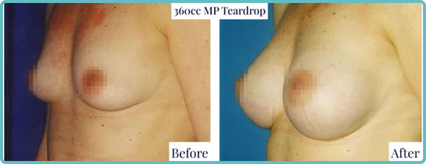 Breast Implants & Enlargement Gallery Before and After Image