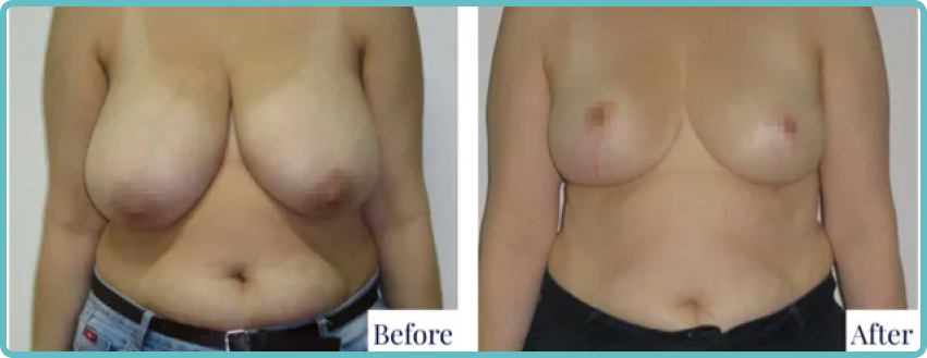 Breast Reduction Surgery Gallery Before and After Image