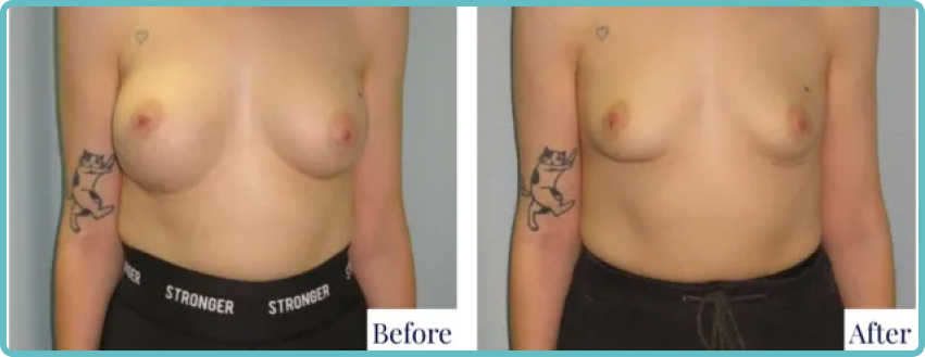 Breast Revision Surgery Gallery Before and After Image