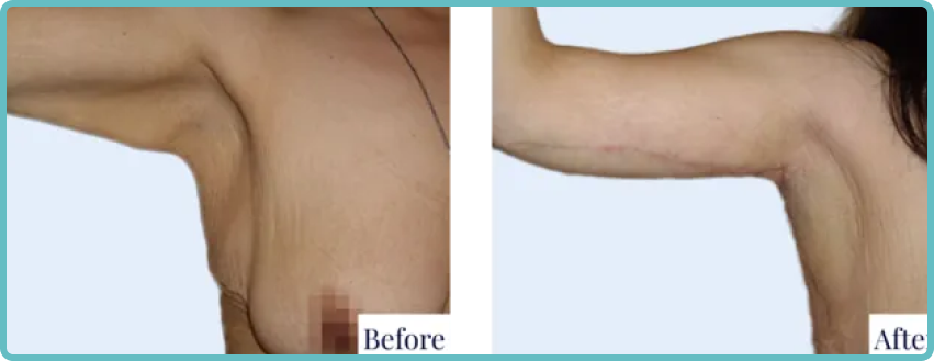 Arm Lift Surgery Gallery Before and After Image