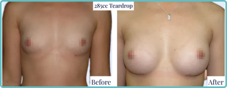 Breast Implants & Enlargement Gallery Before and After Image