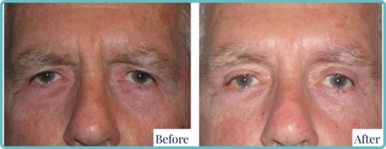 Eyelid Surgery Before and After Photo - Dr Mark Kohout