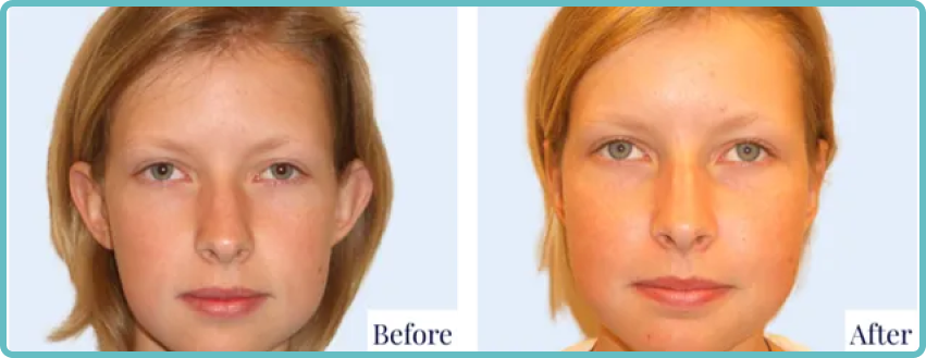 Otoplasty Surgery Gallery Before and After Image