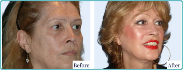 Facelift Surgery Before and After by Dr Mark Kohout