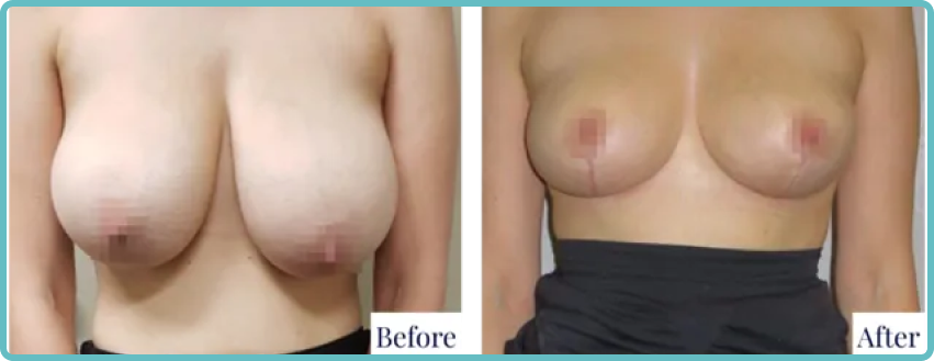 Breast ReductionSurgery Gallery Before and After Image