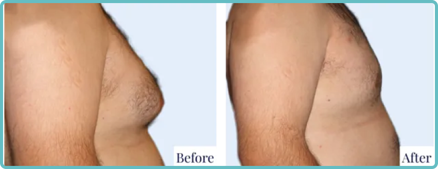 Male Breast Revision Gallery Before and After Image
