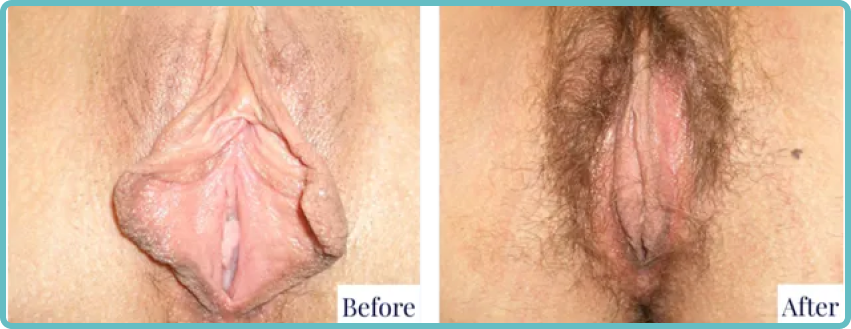 Male Breast Revision Surgery Gallery Before and After Image