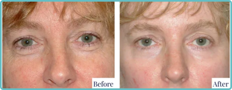 Eyelid Surgery Before and After Photo - Dr Mark Kohout