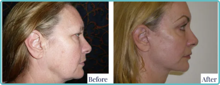 Facelift Surgery Before and After by Dr Mark Kohout