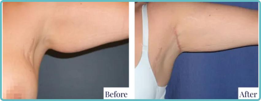 Arm Lift Surgery Gallery Before and After Image