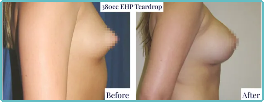 Breast Implants & Enlargement Gallery Before and After Image