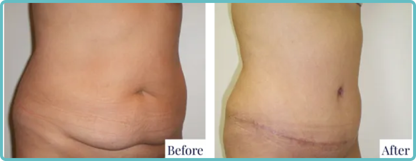 Abdominoplasty Surgery Gallery Before and After Image