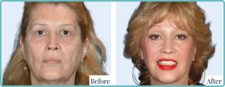 Facelift Surgery Before and After by Dr Mark Kohout