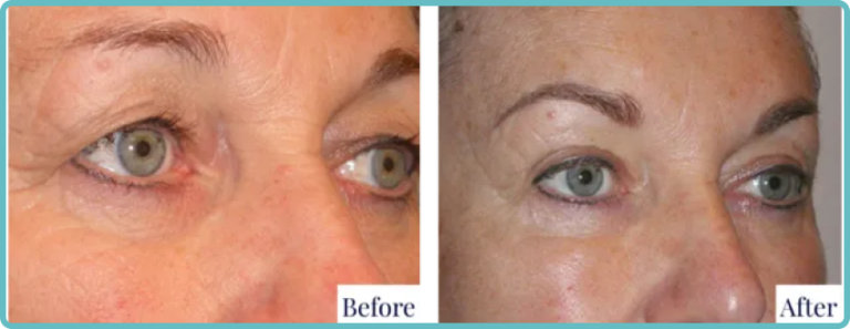 Eyelid Surgery Before and After Photo - Dr Mark Kohout