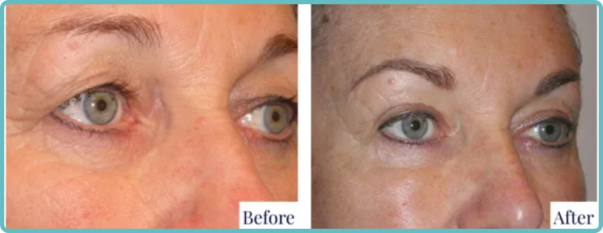 Eyelid Surgery Before and After Photo - Dr Mark Kohout