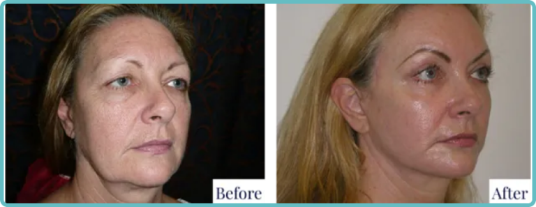 Facelift Surgery Before and After by Dr Mark Kohout