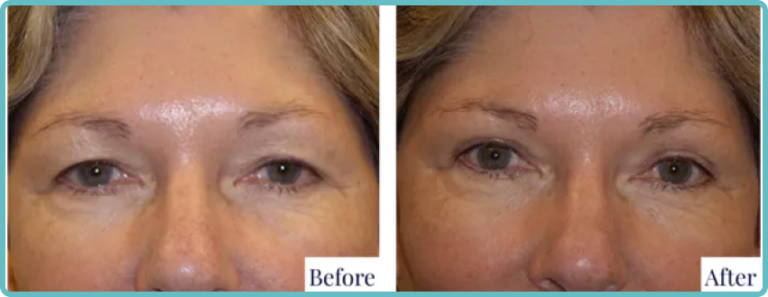 Eyelid Surgery Before and After Photo - Dr Mark Kohout