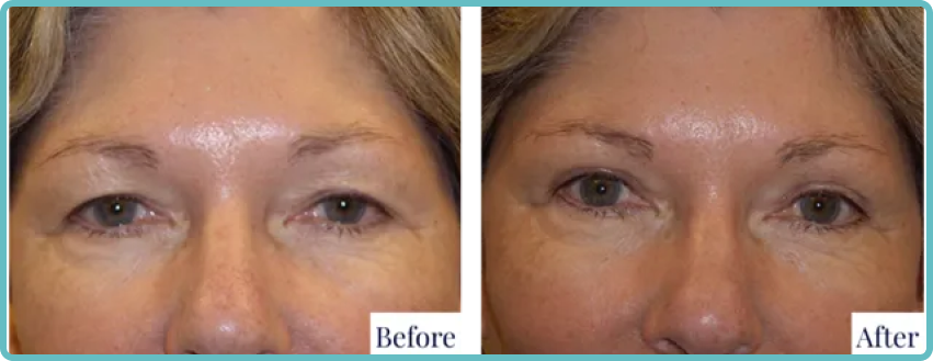 Eyelid Surgery Before and After Photo - Dr Mark Kohout