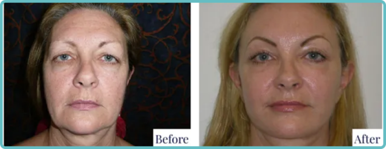 Facelift Surgery Before and After by Dr Mark Kohout