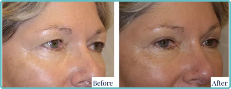 Eyelid Surgery Before and After Photo - Dr Mark Kohout