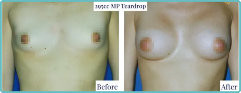 Breast Implants & Enlargement Gallery Before and After Image
