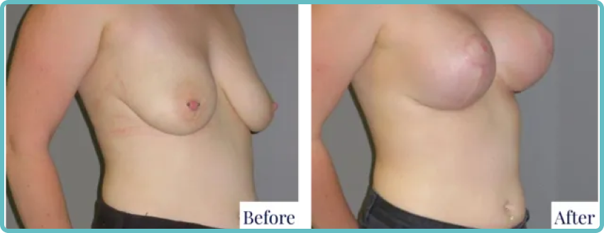 Breast Lift Gallery Before and After Image