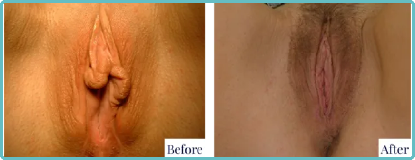 Recovery After Vaginoplasty