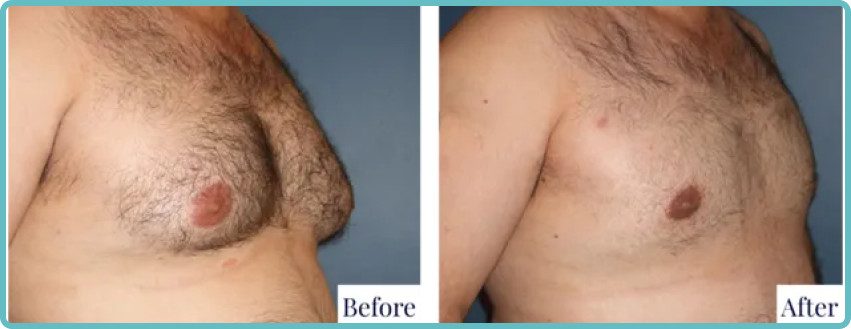 Male Breast Revision Gallery Before and After Image