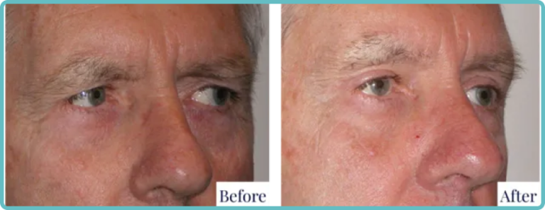 Eyelid Surgery Before and After Photo - Dr Mark Kohout