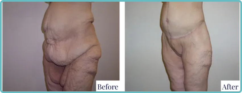 Bodylift Surgery Faqs - Before and After image
