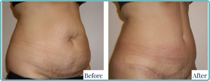 Abdominoplasty Surgery Gallery Before and After Image