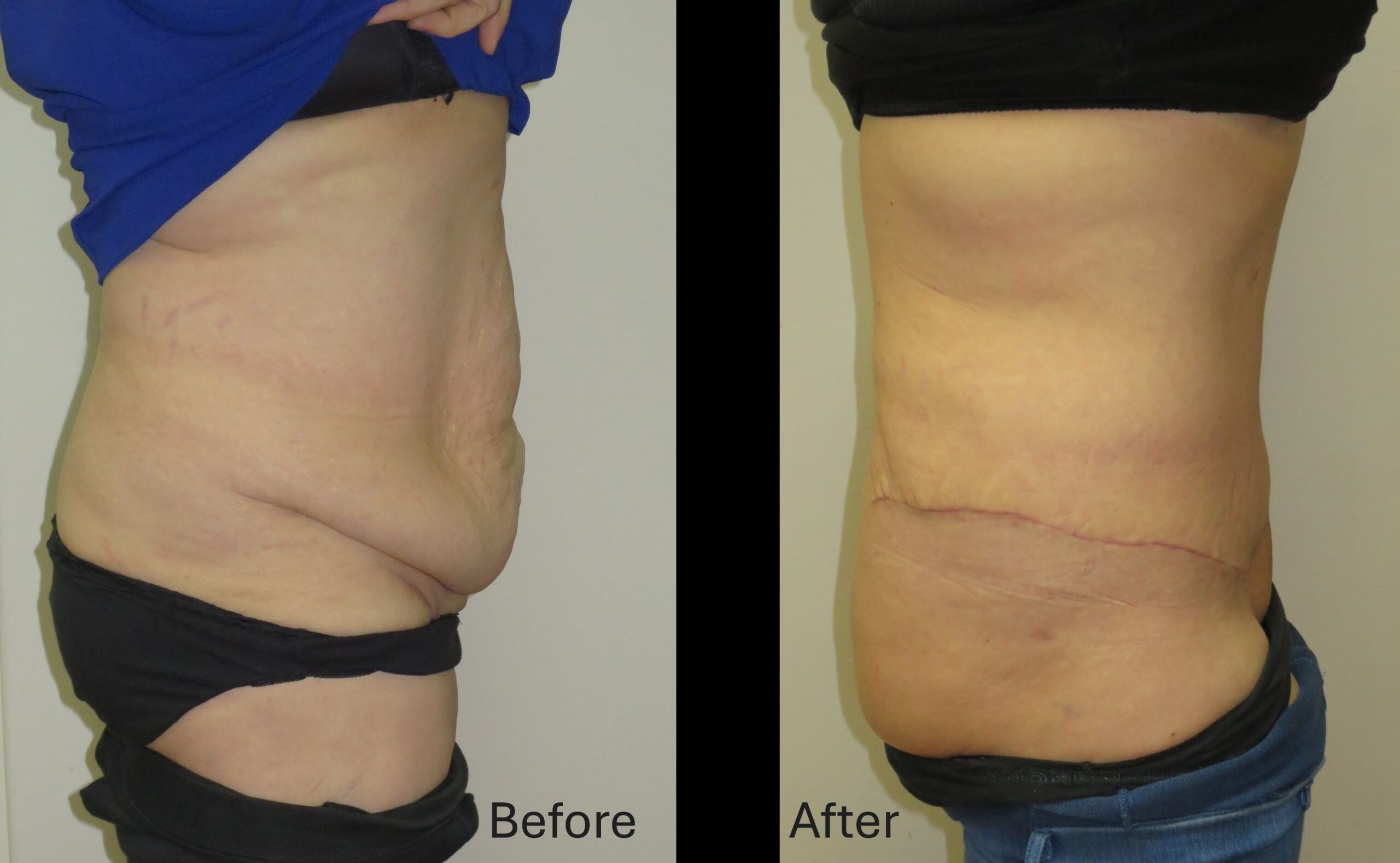 Abdominoplasty Surgery Gallery Before and After Image