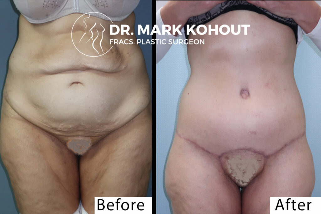 Abdominoplasty by Dr Kohout 1003