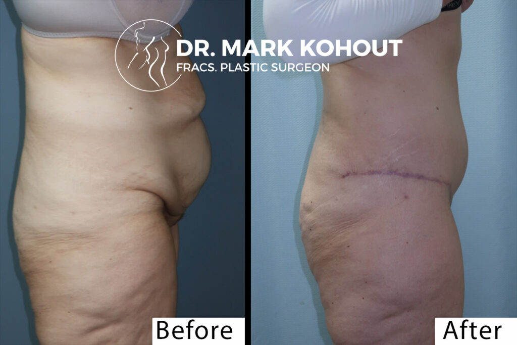 Abdominoplasty by Dr Kohout 1003