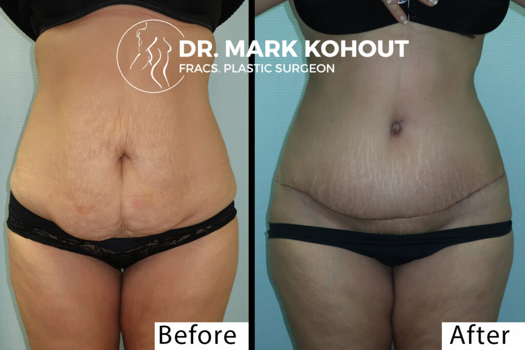 Abdominoplasty by Dr Kohout 1004