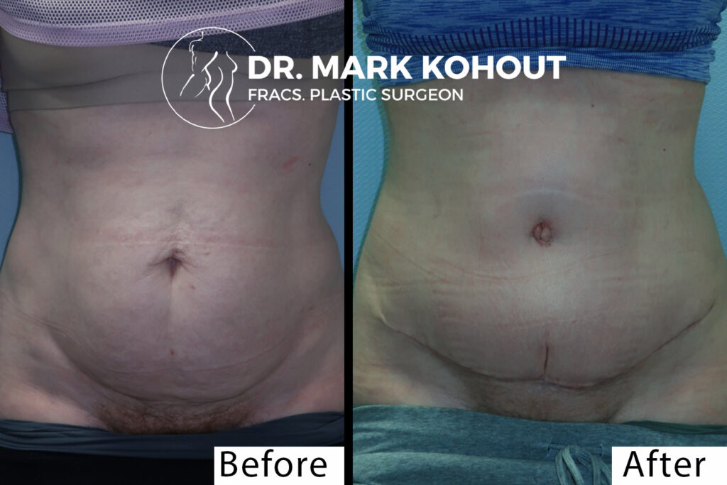Abdominoplasty by Dr Kohout 1005