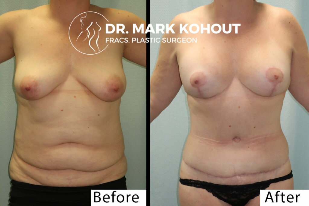 Abdominoplasty and Breast lift Mastopexy by Dr Kohout 1008
