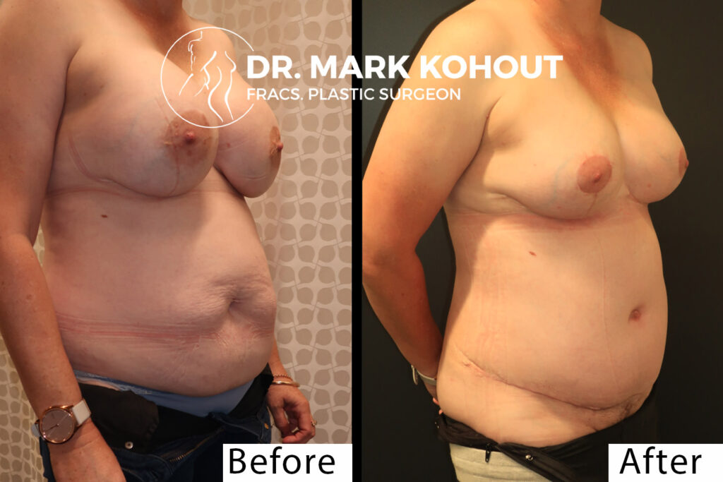 Abdominoplasty implant removal and Breast lift Mastopexy by Dr Kohout 1013
