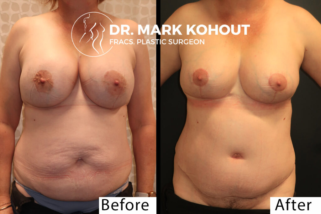 Abdominoplasty implant removal and Breast lift Mastopexy by Dr Kohout 1013