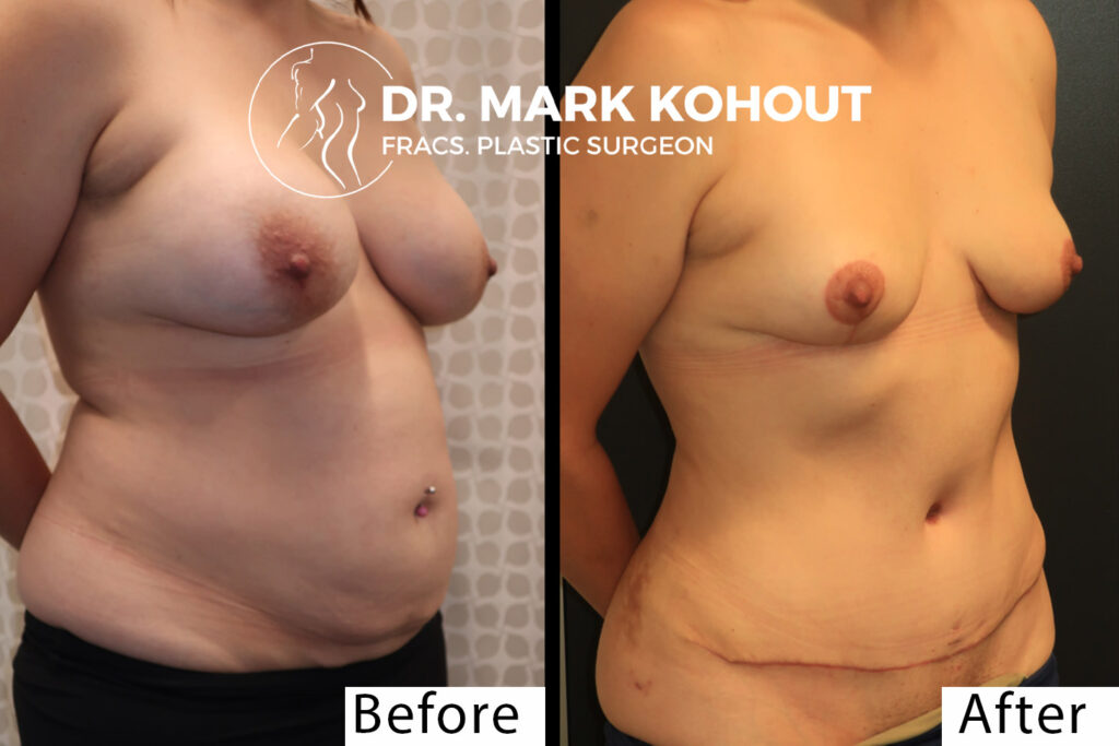 Abdominoplasty implant removal and Breast lift Mastopexy by Dr Kohout 1014