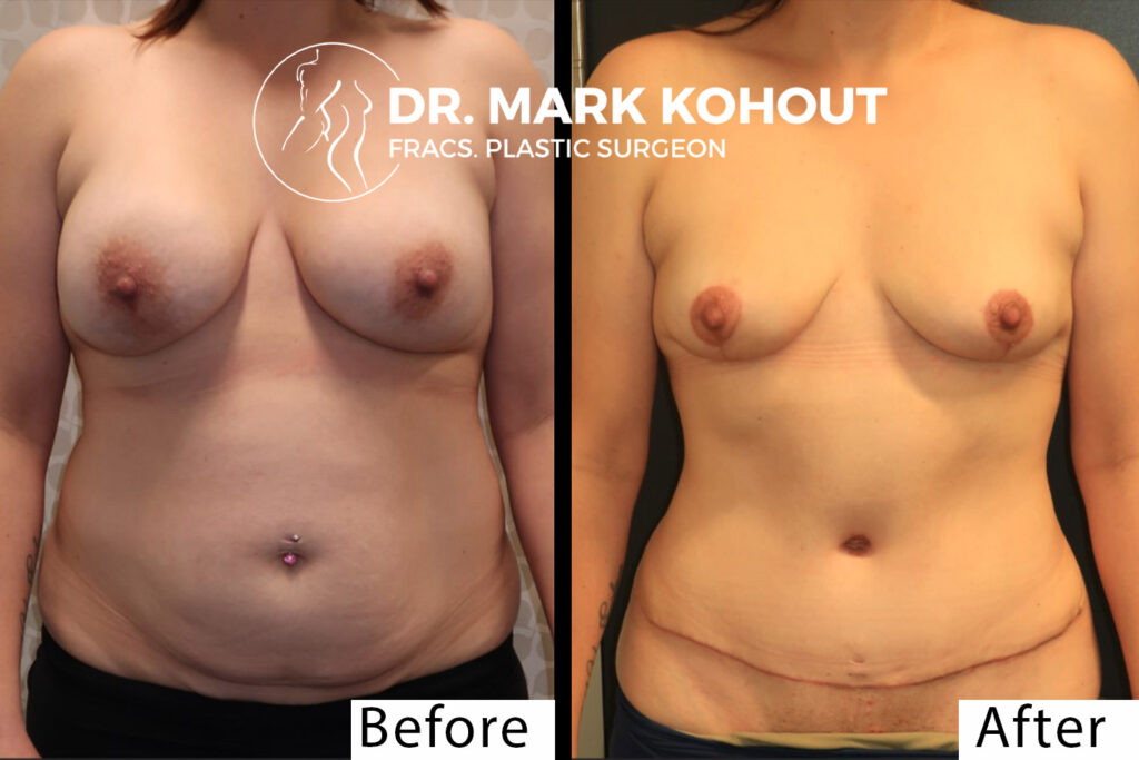 Breast Implant Removal Surgery Before and After