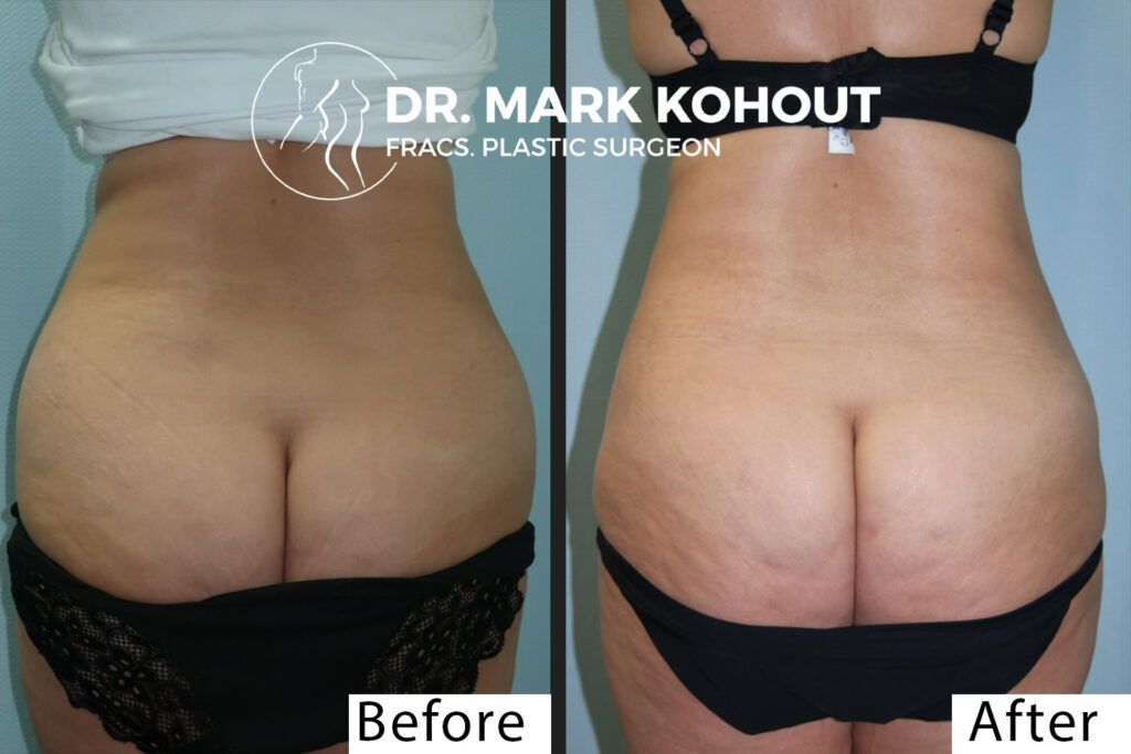 Mini Tummy tuck lower Abdominoplasty and Liposuction by Dr Kohout 1015