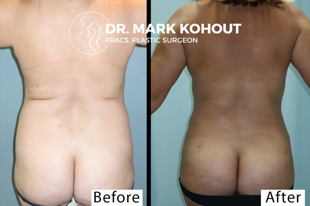 Abdominoplasty Tummy tuck Breastlift Mastopexy and back Liposuction by DrKohout 1017